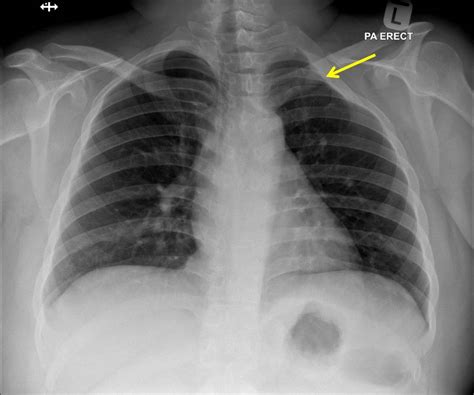 poland syndrome chest pain